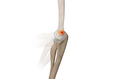 Posterior Impingement of the Elbow