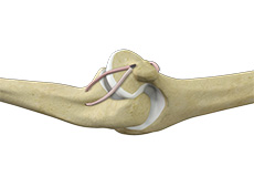 UCL Reconstruction (Tommy John Surgery)
